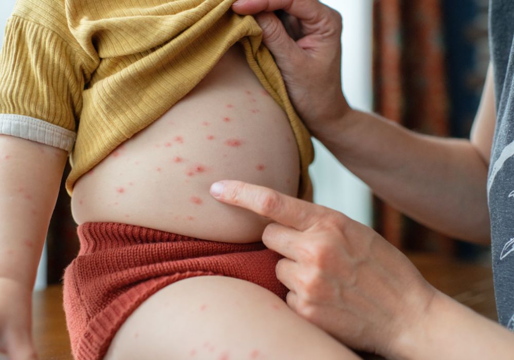 Child with chickenpox