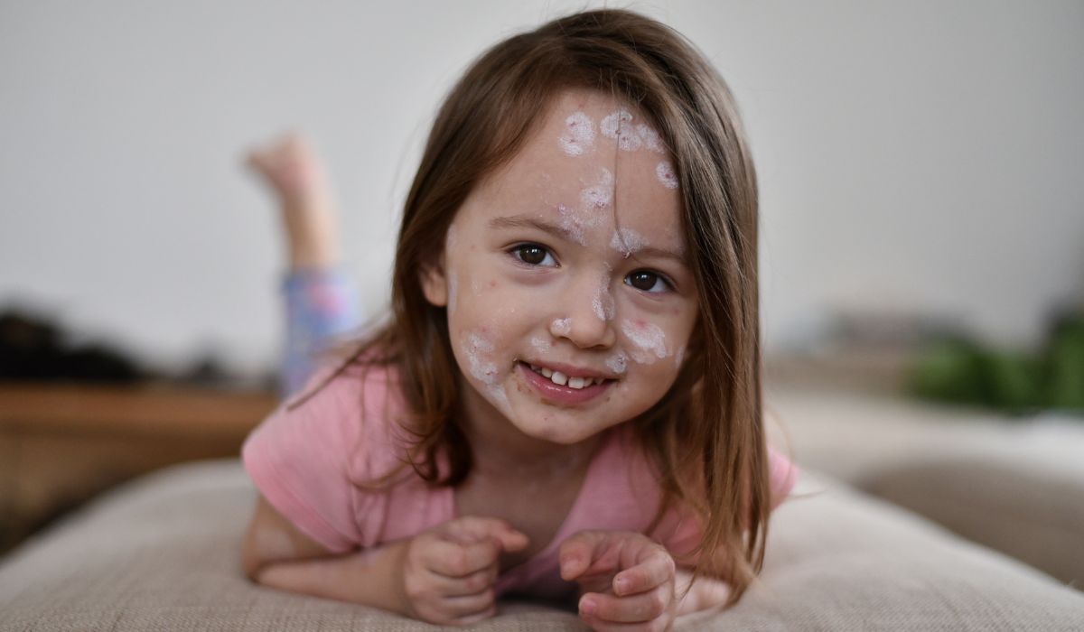 Chicken pox