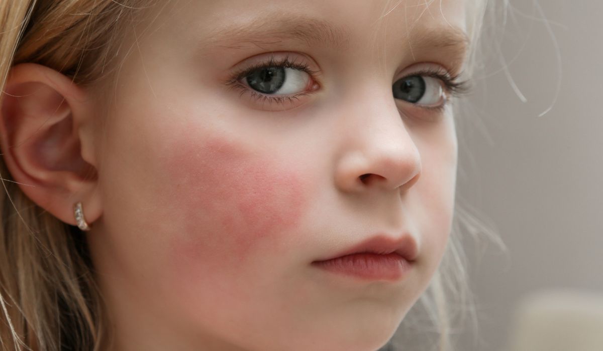 Slapped cheek syndrome