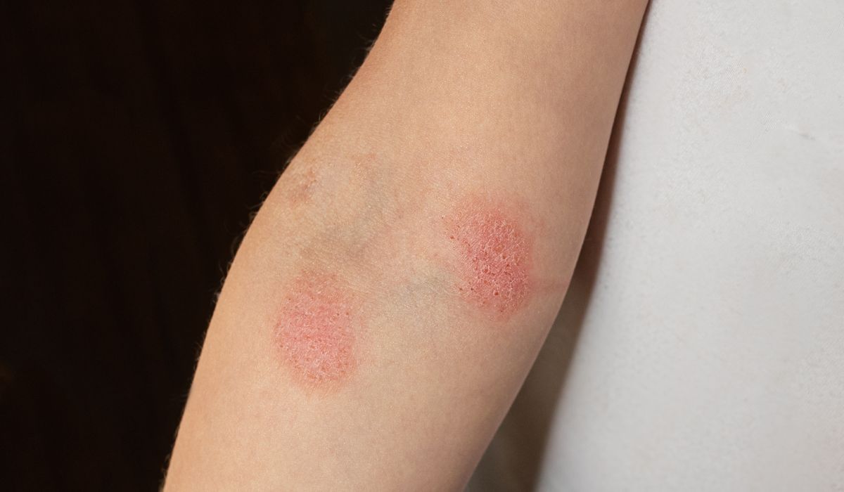 Ringworm