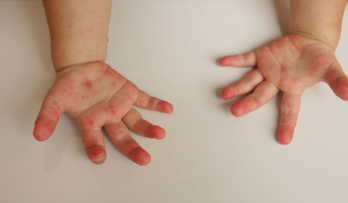 Hand foot and mouth symptoms