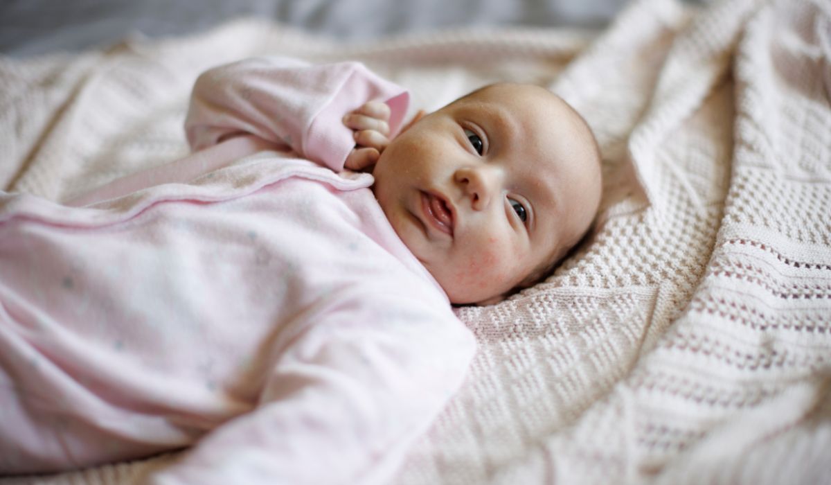 Baby with eczema