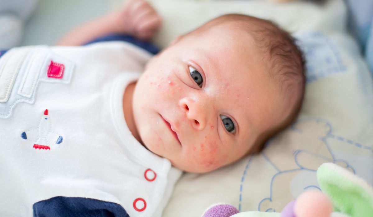 Baby with eczema