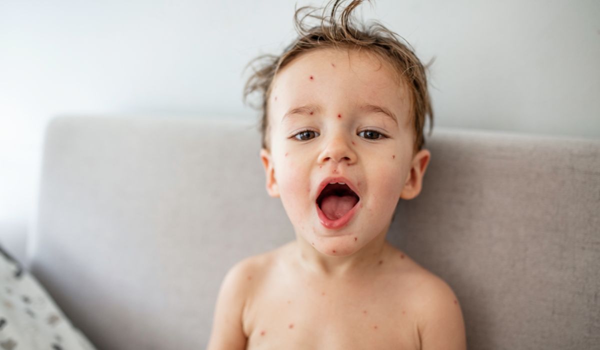 Child with chickenpox