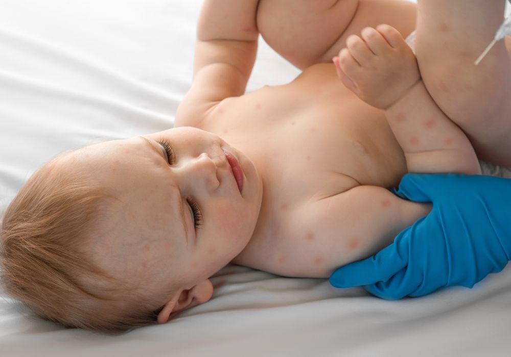 Child with measles