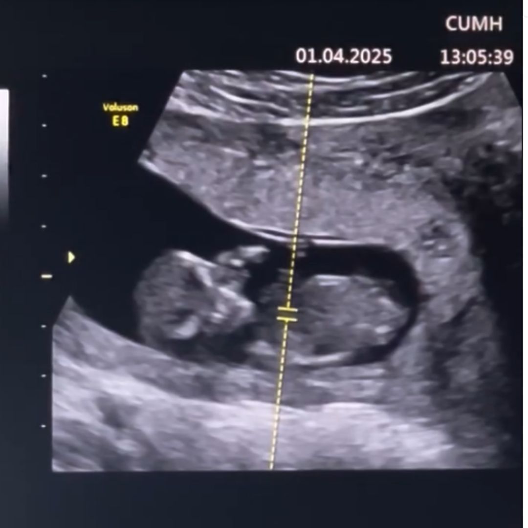 Aoife O’Sullivan and Colm Spillane's baby scan