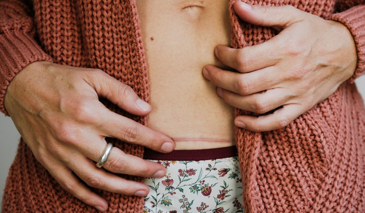 Woman feeling her C-Section scar