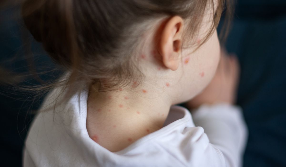 Little girl with measles