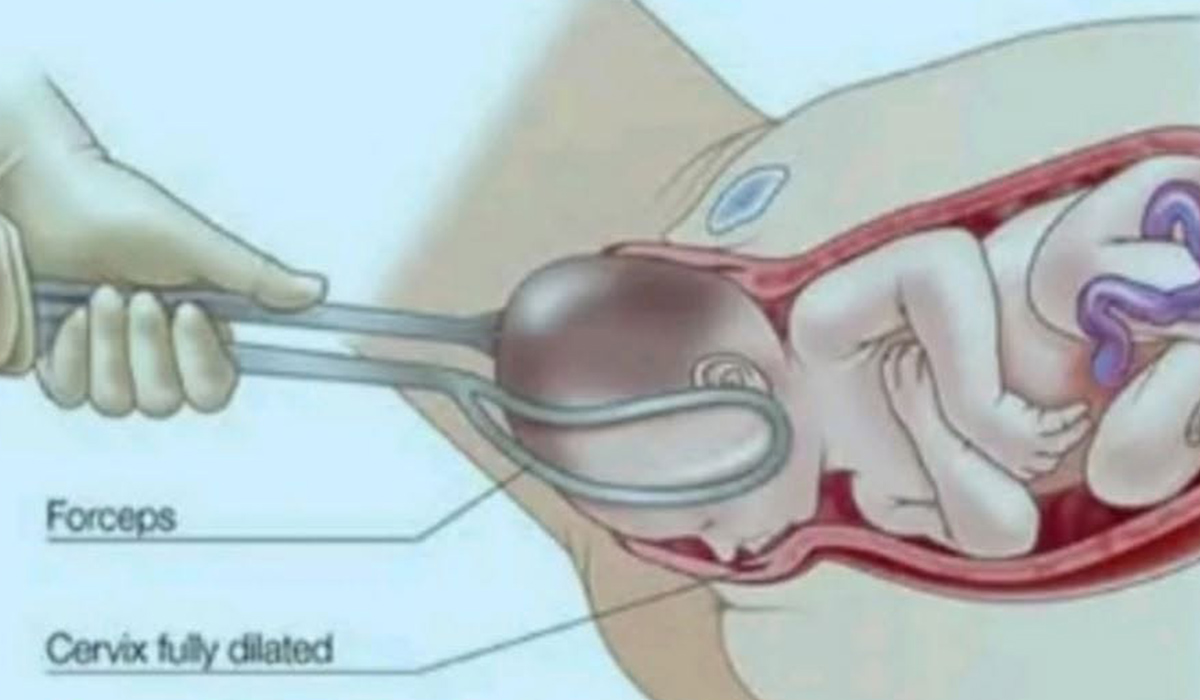 Forceps delivery. Pic: Ahmed MediCo/Facebook