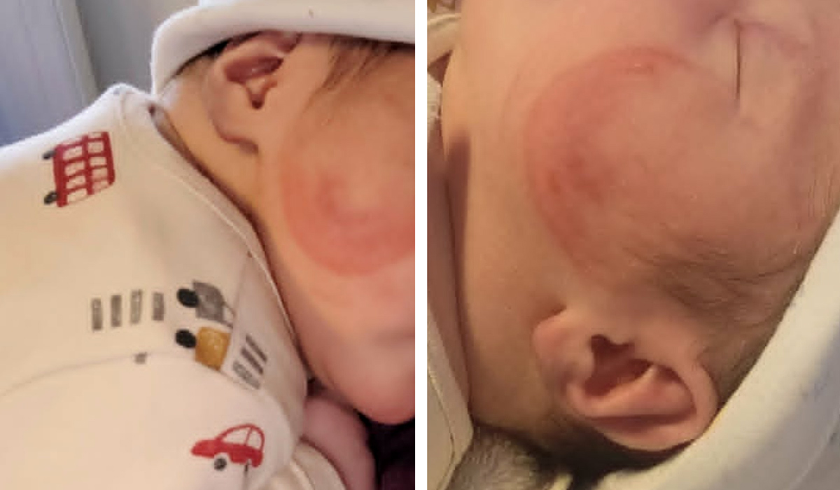 The forceps mark on Alexander's face. Pic: Supplied