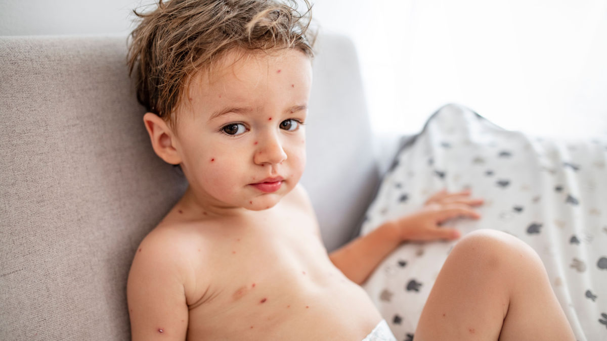 Young boy with chickenpox